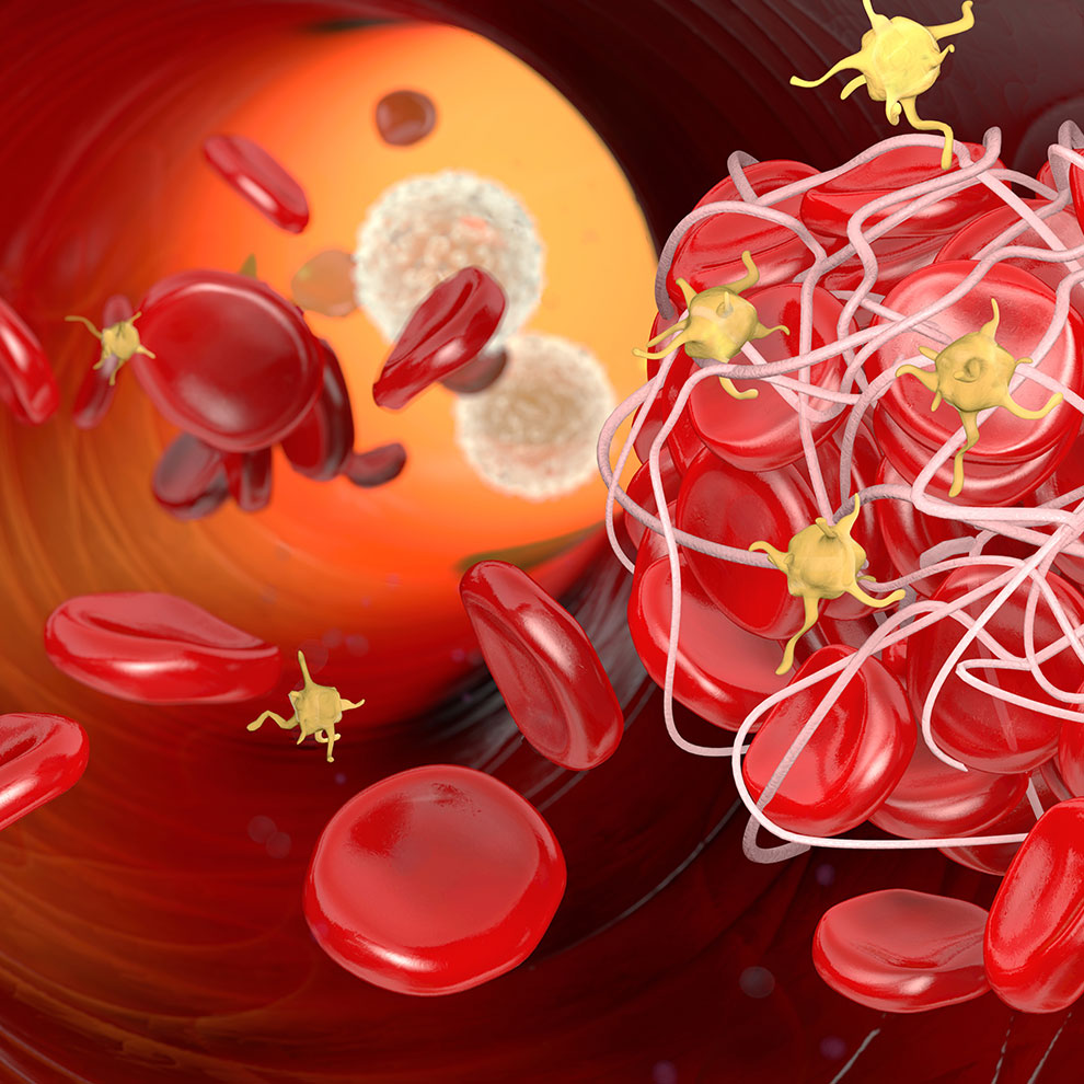 Der d-Dimer-Test hilft Ihnen eine Thrombose rechtzeitig zu erkennen.